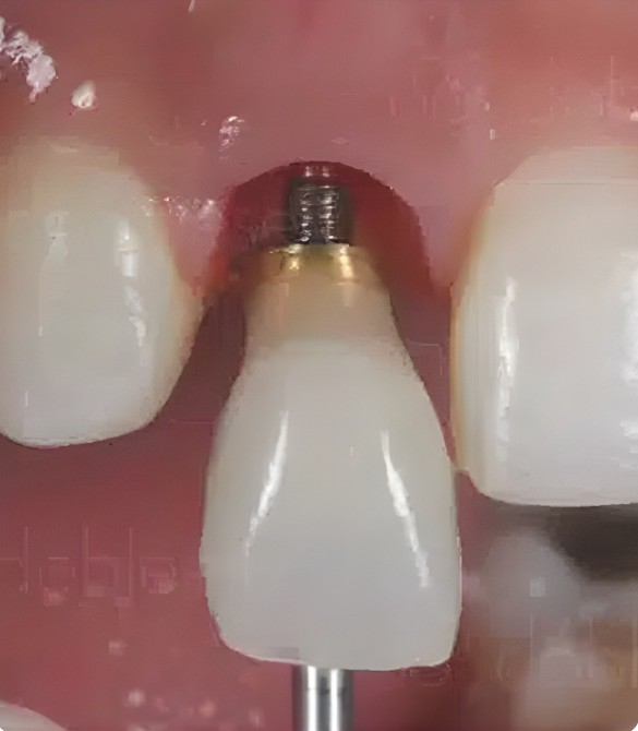 Implantes Dentales